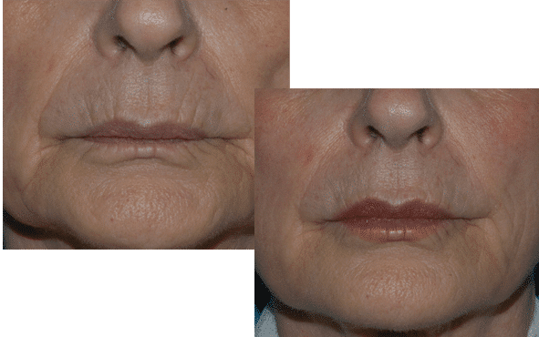 Before and after dermal fillers by Dr. Brunner in Princeton, NJ