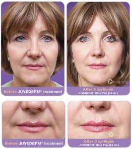 Before and after Juvederm filler