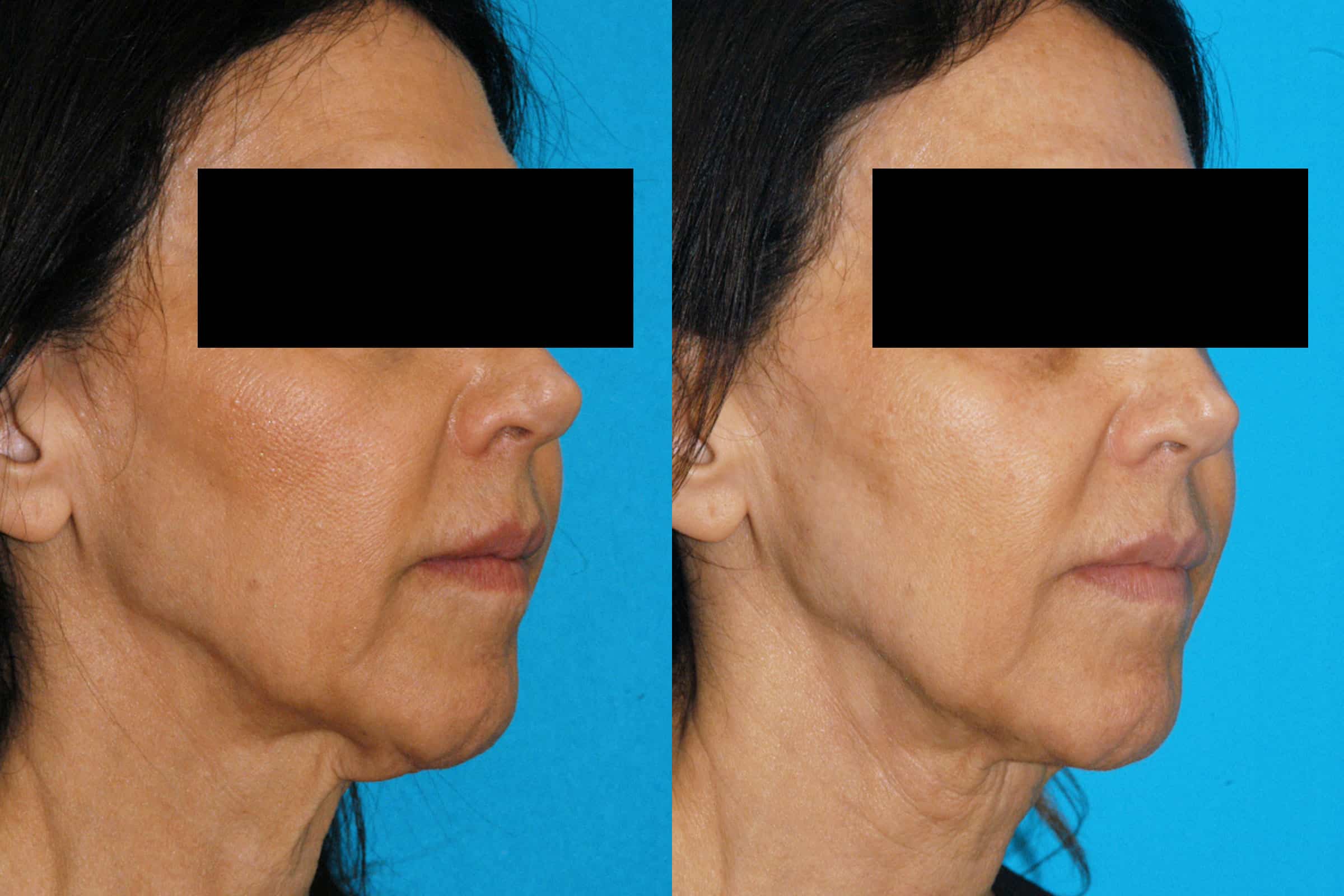 FaceTite Procedure