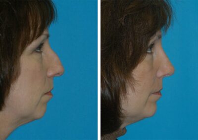 rhinoplasty before after in princeton, nj