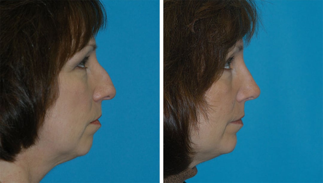 Rhinoplasty and Chin Augmentation rhinoplasty before after in princeton, nj