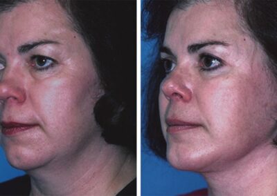 Facelift and Chin Implants to Define Neck and Jawline