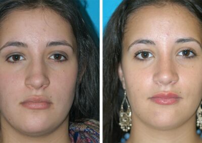 Eugenie Brunner Before after Rhinoplasty Princeton New Jersey