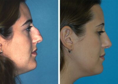 Eugenie Brunner Rhinoplasty Before After Princeton New Jersey