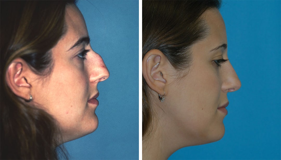 Rhinoplasty to Improve Nose Profile Eugenie Brunner Rhinoplasty Before After Princeton New Jersey