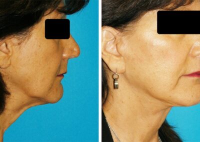 facelift new jersey