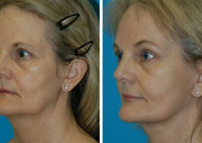 Facelift & Browlift