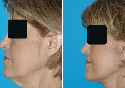 Facelift & Necklift