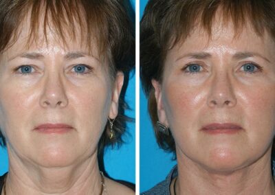 Facelift & Necklift