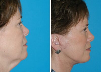 Facelift & Necklift