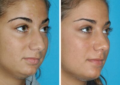 Princeton New Jersey Rhinoplasty Before After Eugenie Brunner