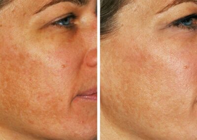 hyperpigmentation treatment results