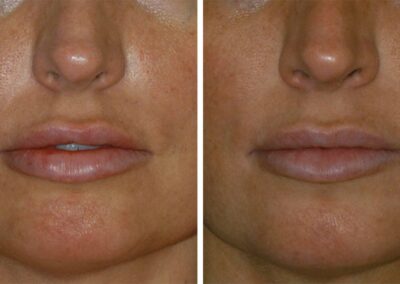 Dermal Fillers