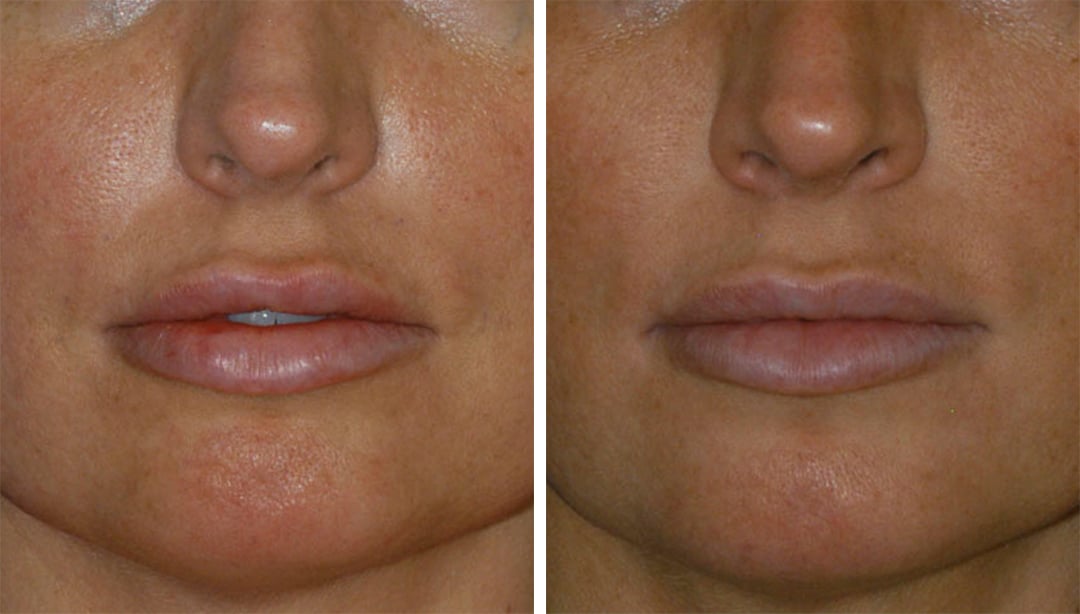 Dermal Fillers for lip augmentation