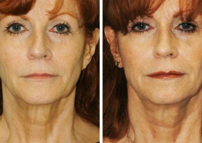 EmbraceRF Facial Rejuvenation Before After Princeton NJ