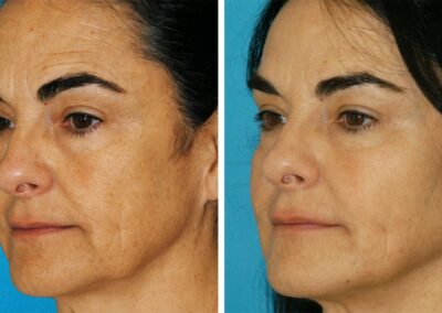 Dr. Brunner's signature Tri-Zone Laser Lift