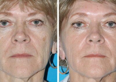 Eugenie Brunner Fraxel Laser Treatment Results Princeton NJ