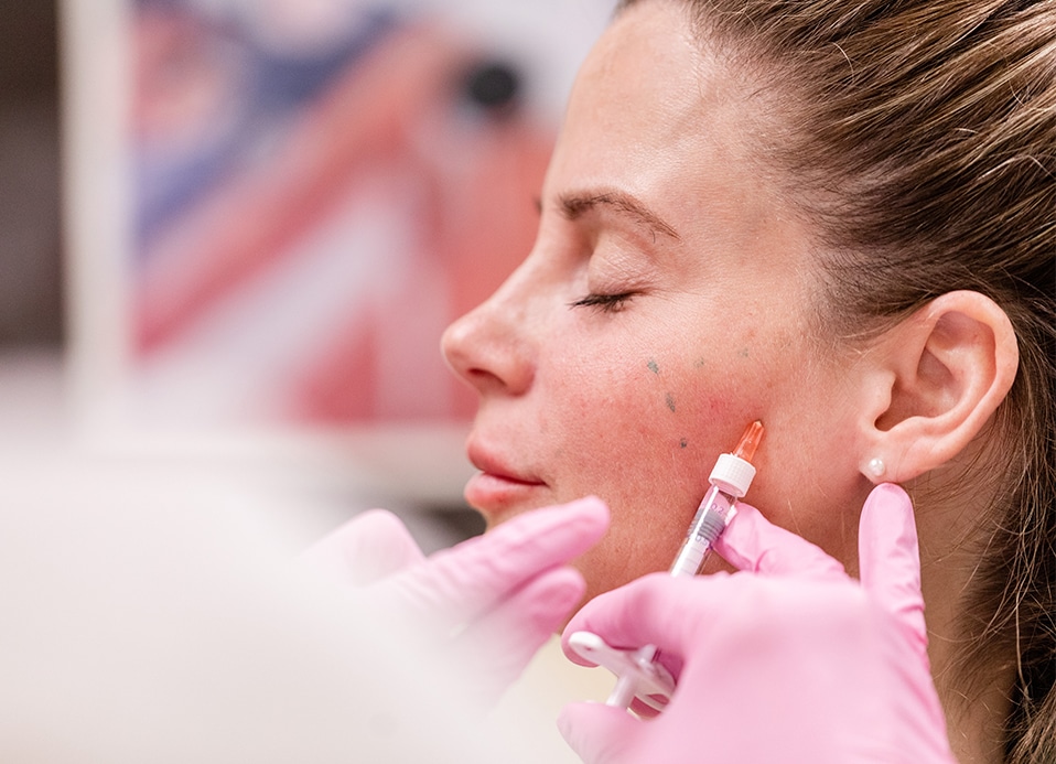 Woman getting a Radiesse injectable filler