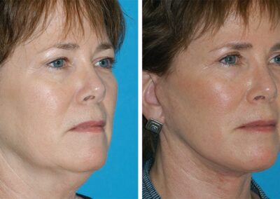 Facelift & Necklift