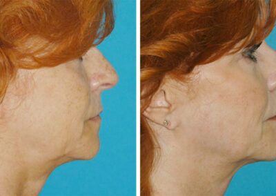 Fractora RF Skin Tightening