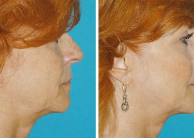 Fractora RF Skin Tightening