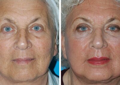 Fraxel Laser Dual Before After Results Princeton NJ