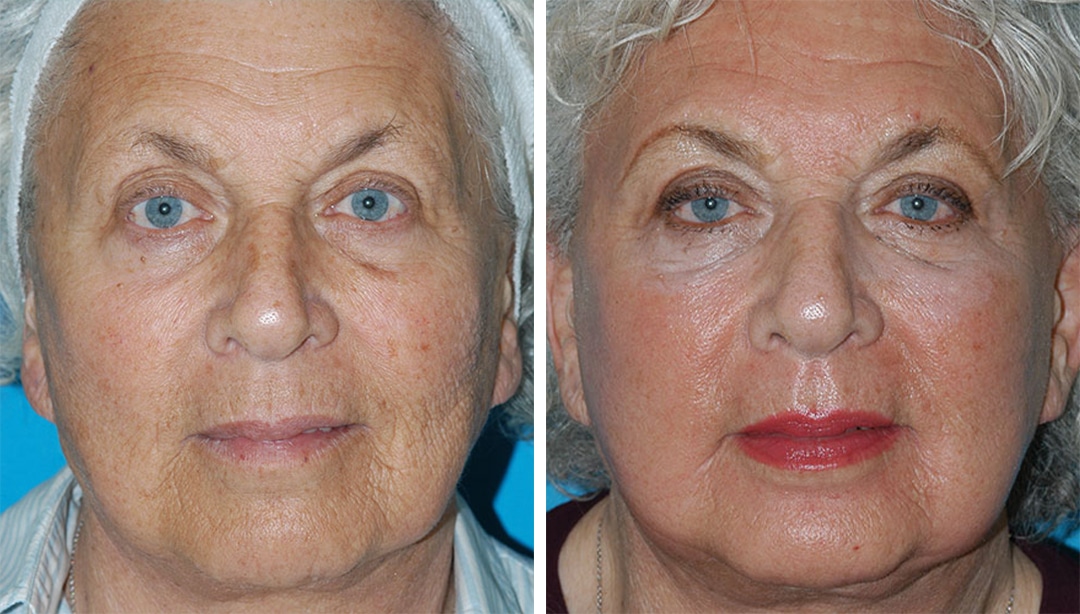 fraxel laser therapy before and after