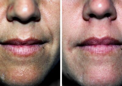 Juvederm Voluma Injection to the Lips