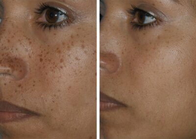 KTP Laser Pigmentation Before After Princeton NJ