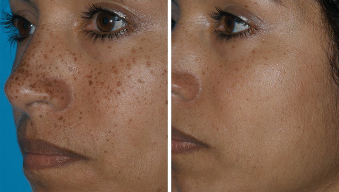 laser skin resurfacing before and after