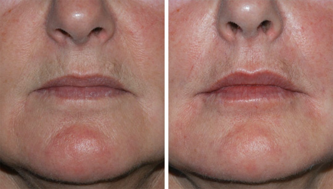 Dermal Fillers for Lip Volume Lip Augmentation results