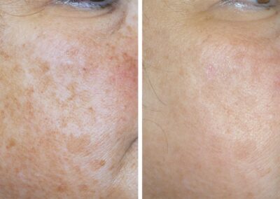 hyperpigmentation before and after