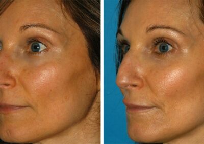 PicoSure Laser Skin Rejuvenation Results Princeton NJ