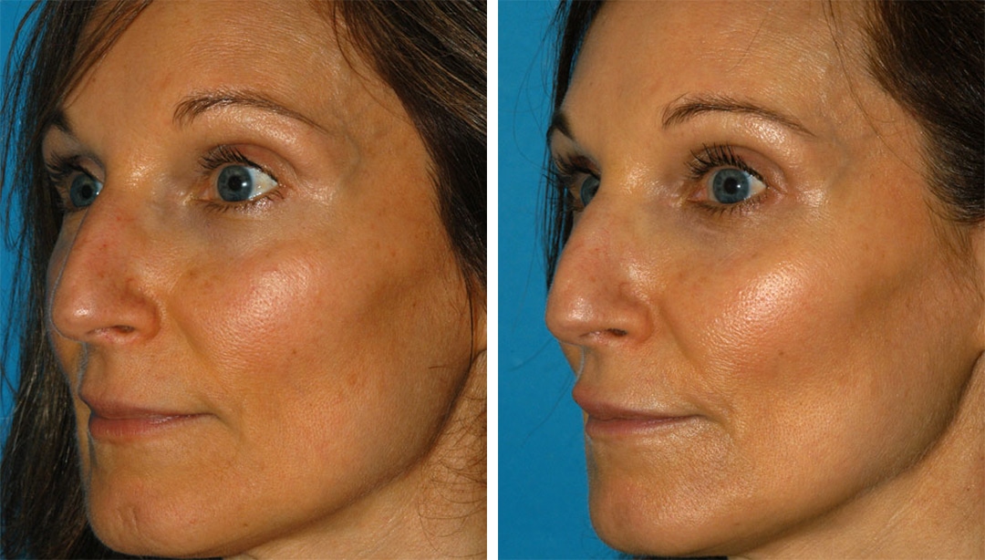 PicoSure laser treatment for facial rejuvenation. After procedure, skin is smoother and sun damage is noticeably reduced. Disclaimer: Results are not guaranteed. Results vary from patient to patient.