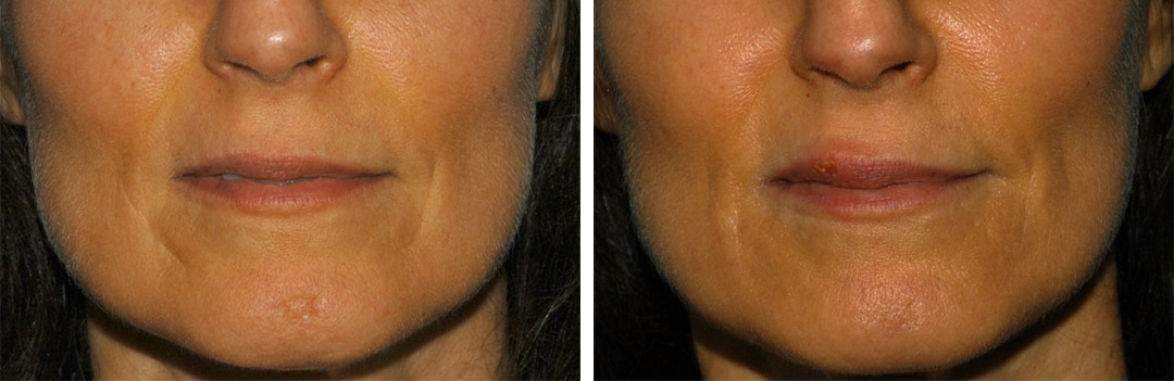 laser treatments results in princeton nj