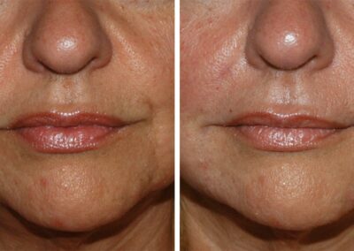 Restylane Filler Injection to the Lips