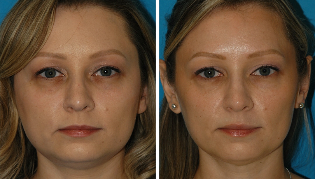 Clear + Brilliant, Botox, and Restylane for Facial Rejuvnenation before and after botox in Princeton, NJ