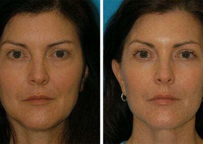 facial assymmetry corrected