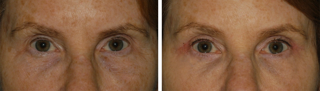 Blepharoplasty for Eye Rejuvenation hooded eyes correction in princeton nj