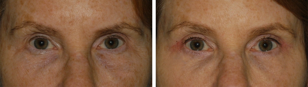 hooded eyes correction in princeton nj