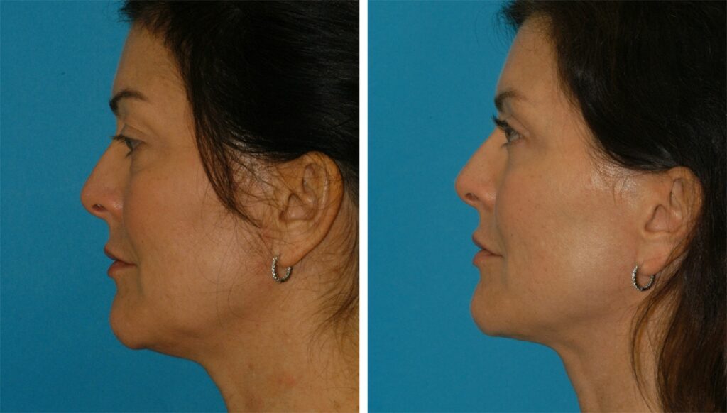 liquid facelift in Princeton results