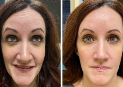 botox before and after results