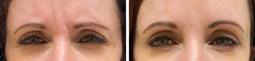 Treatment for Frown Lines Before and after wrinkle treatment fillers