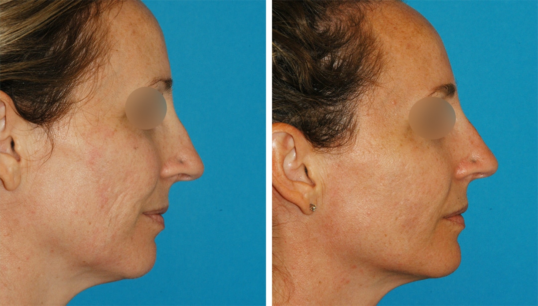Microneedling with PRP and Fillers for Facial Rejuvenation radiesse filler before and after