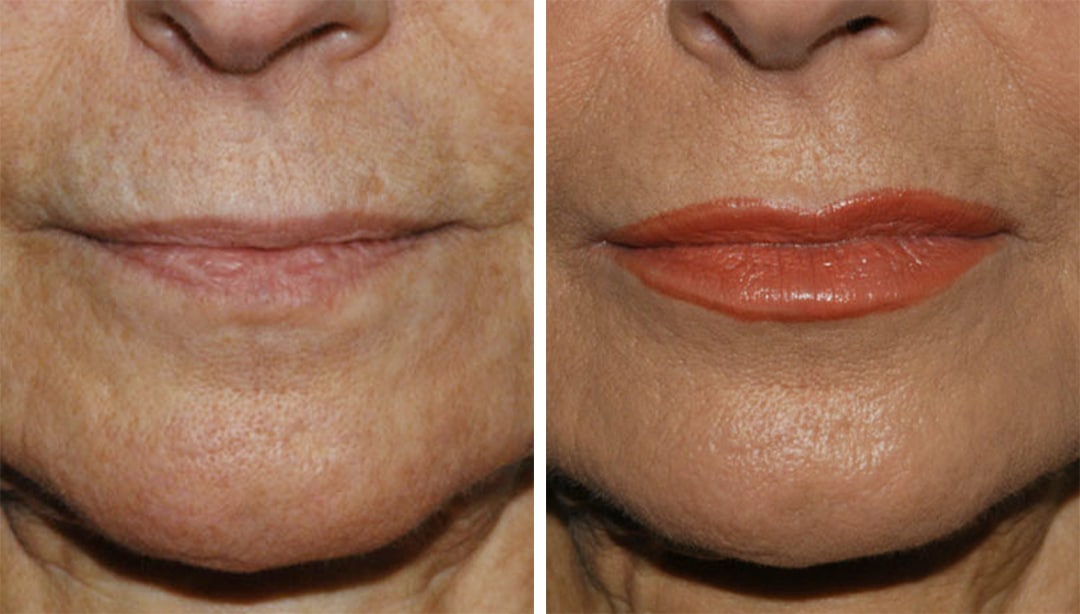 Restylane Kysse to Plump Up Lips facial contouring with lip fillers