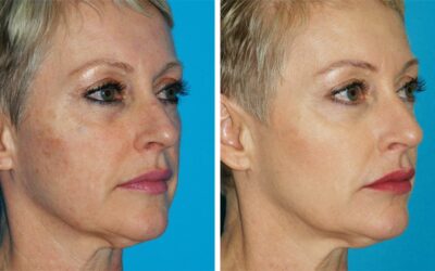 How One Woman Approached Anti-Aging Treatments Over the Years