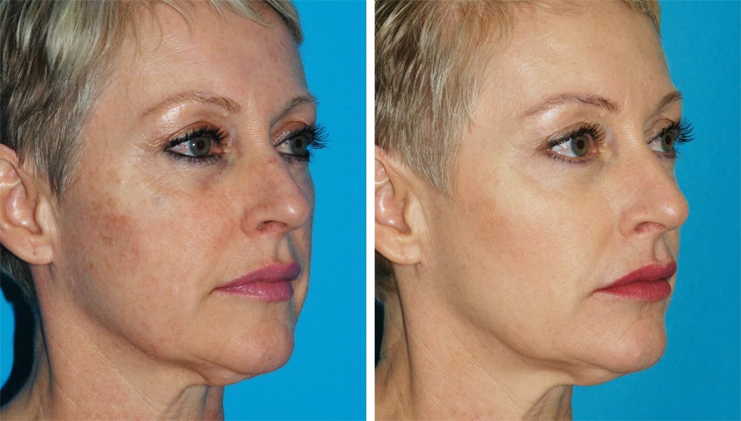 Varilite Laser, Filler, SmartLipo, Facelift, Upper Eyelid Lift for Facial Rejuvenation facial skin tightening before and after