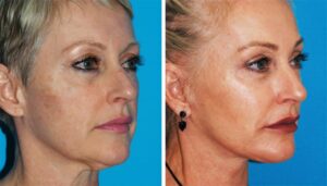 facelift plastic surgery in princeton, nj