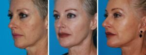 facelift facial plastic surgery procedure in princeton, nj