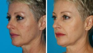 laser dermatology treatments in prinecton, nj